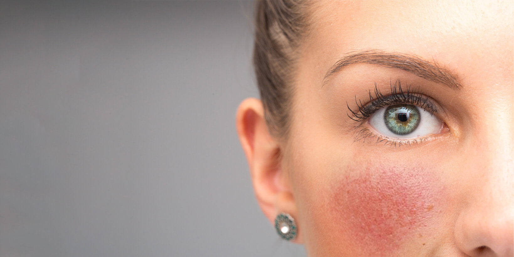 Redness & Rosacea